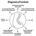 Diagnosis of lordosis. Spinal curvature, kyphosis, lordosis, scoliosis, arthrosis. Improper posture and stoop