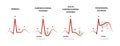 Diagnosis of Myocardial Ischemia