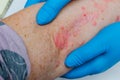 Diagnosis of skin diseases - allergies, psoriasis, eczema, dermatitis. A dermatologist with gloves examines the skin of the elbow