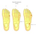 Diagnosis of the tailor's bunion