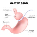 Diagram of an adjustable gastric band Royalty Free Stock Photo