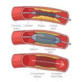 Diagram coronary stent placement medical science