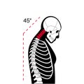 Neck vertebrae deformity