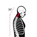 Neck vertebrae deformity