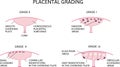 Diagram of placental grading. four grades from 0 to III. S