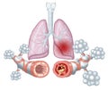 Asthma, normal and asthmatic airways, medically illustration