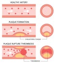 Atherosclerosis stages: healthy artery, plaque formation, and thrombosis in flat style isolated on white background. health care c