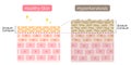 Diagram of skin cell turnover and thickening of the stratum corneum. Skin care and beauty concept