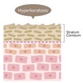 Diagram of skin cell turnover and thickening of the stratum corneum. Skin care and beauty concept