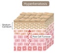 Diagram of skin cell turnover and thickening of the stratum corneum. Skin care and beauty concept