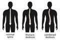 Diagram with spine curvature and healthy spine.