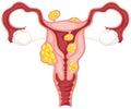 Diagram of subserosal uterine fibroids illustration Royalty Free Stock Photo