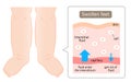 Diagram of swollen feet illustration. swelling is caused by excess fluid within the tissues of the body. Health care concept