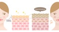 Diagram of thickening of the stratum corneum and woman face.Ã£â¬â¬beauty treatment Before after illustration. Skin care and beauty