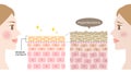 Diagram of thickening of the stratum corneum and woman face. Before after illustration. Skin care and beauty concept