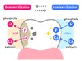 Diagram of tooth demineralization and remineralization. Dental care concept