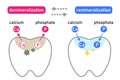 Diagram of tooth demineralization and remineralization. Dental care concept