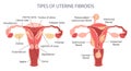 Diagram of types of uterine fibroids in a woman. Healthy and unhealthy uterus. Genicology. Medical concept. Infographic banner. Royalty Free Stock Photo