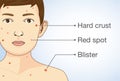 Diagram of the varicella infection in a child.