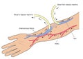 Dialysis arteriovenous fistula