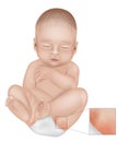 Diaper Rash or Irritant Diaper Dermatitis. Inflammation of the skin under a diaper. Jacquet Dermatitis. Infant with diaper rash in