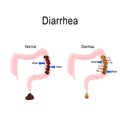 Diarrhea and dysentery