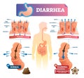 Diarrhea vector illustration. Labeled stomach gut illness medical scheme. Royalty Free Stock Photo