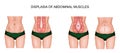 DIASTASIS OF ABDOMINAL MUSCLES