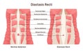 Diastasis rect. Abdominal muscles separation. Human torso muscles