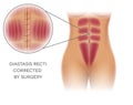 Diastasis Recti repair Royalty Free Stock Photo