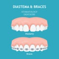 Diastema and Braces. Stomatology dentistry vector concept