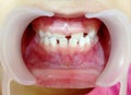 The diastema teeth on child