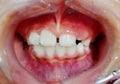 The diastema teeth on child