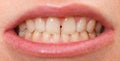 Diastema between the upper incisors