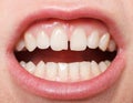 Diastema between the upper incisors Royalty Free Stock Photo