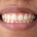 Diastema between the upper incisors Royalty Free Stock Photo