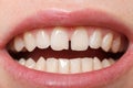 Diastema between the upper incisors Royalty Free Stock Photo