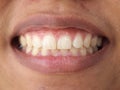 Diastema between the upper incisors Royalty Free Stock Photo