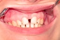 Diastema of the upper jaw Royalty Free Stock Photo