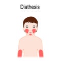 Diathesis. Atopic dermatitis atopic eczema. Location on a huma Royalty Free Stock Photo