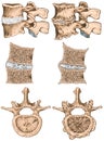 Advanced uncovertebral arthrosis