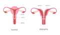 Didelphis and normal human uterus structure. Uterine deep septum as a congenital uterine malformation. Anatomy chart.