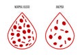 The difference of Anemia amount of red blood cell and normal. Illustration about medical.