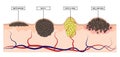 The difference between a birthmark, mole, papilloma and melanoma. Infographics