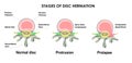 Difference between Bulging Disc and Herniated Disc. Stages of Spinal Disc extrusion. Graphic illustration Royalty Free Stock Photo