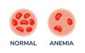 The difference comparison of a drop of blood with normal and anemic cells under microscope vector Medical illustration