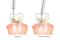 Difference of the Periodontal Scaling and Root Planing. Oral hygiene and conventional periodontal therapy. Human teeth