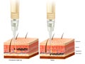 Difference between tattoo and permanent make-up process. Pigment under layers skin of Epidermis, Dermis and Gipodermis. Royalty Free Stock Photo