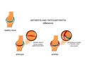 Differences arthrosis from arthritis Royalty Free Stock Photo