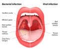 The differences between viral and bacterial infections